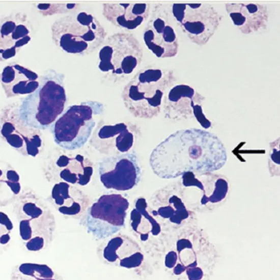 Primary Amoebic Meningoencephalitis PAM